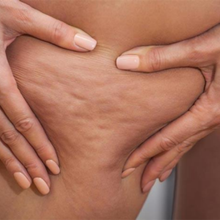 cellulite-what-is-it-featured-image