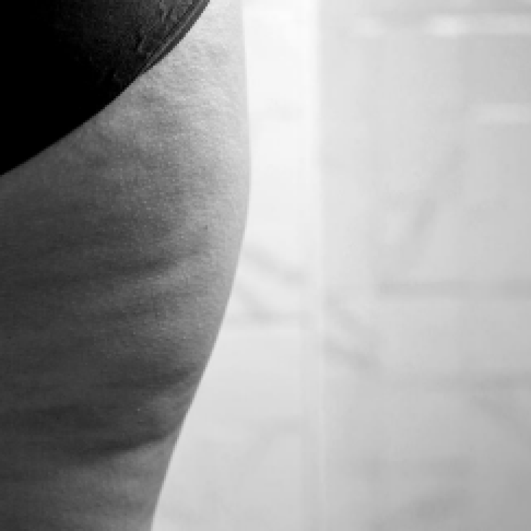 types-of-cellulite-featured-image